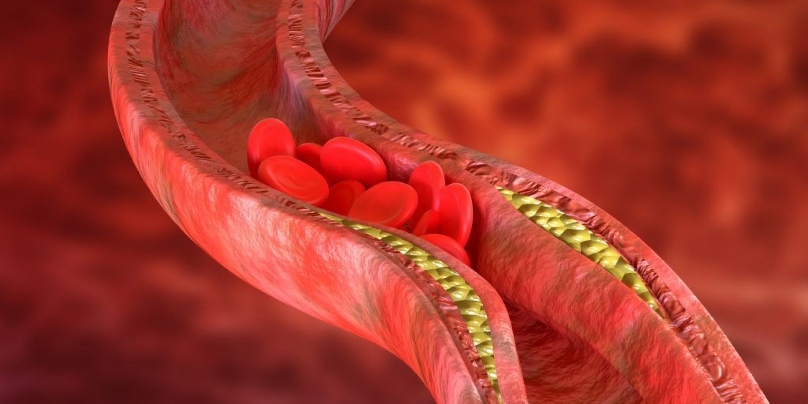 Atherosclerosis is an accumulation of cholesterol plaques in the walls of the arteries, which causes obstruction of blood flow.